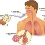 Hantavirus pulmonary syndrome