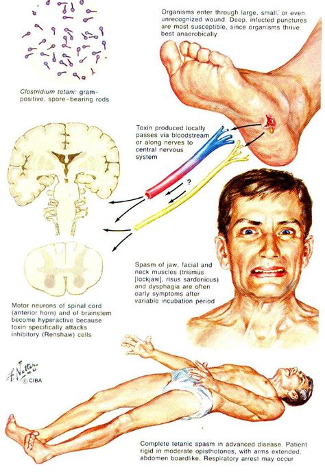 Tetanus Poisoning - Guide to Poisoning Symptoms and First Aid