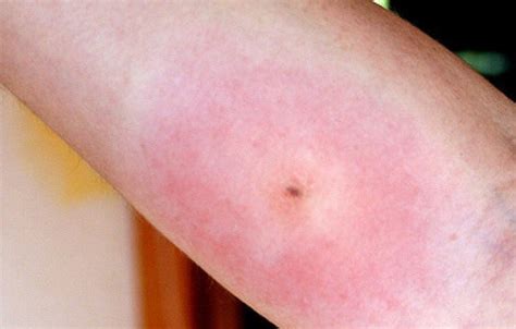 Venomous spider bite poisoning